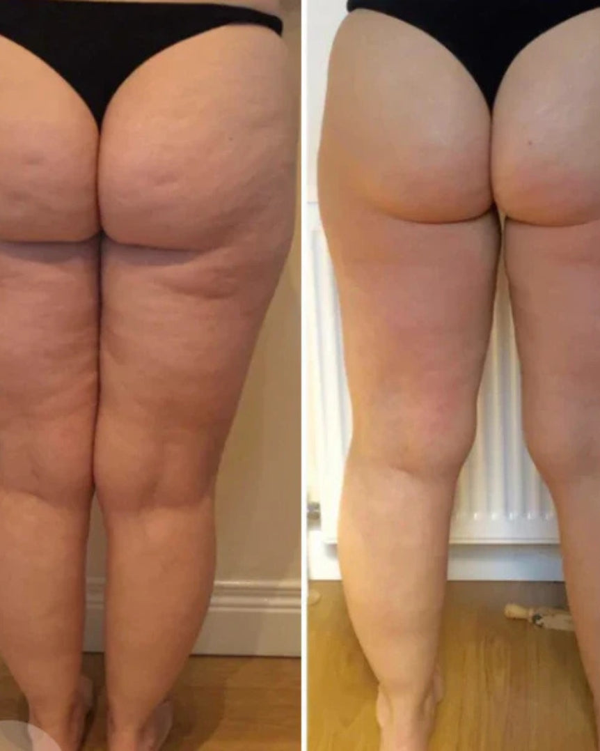 Nest Pro Anti-Cellulite et vergeture
