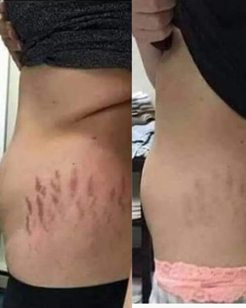 Nest Pro Anti-Cellulite et vergeture